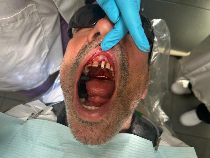 immeadiate implant pin