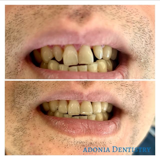 before and after porcelain veneers transformation