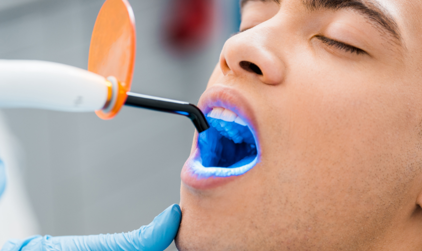 The Superiority of Professional Teeth Whitening Over DIY Kits