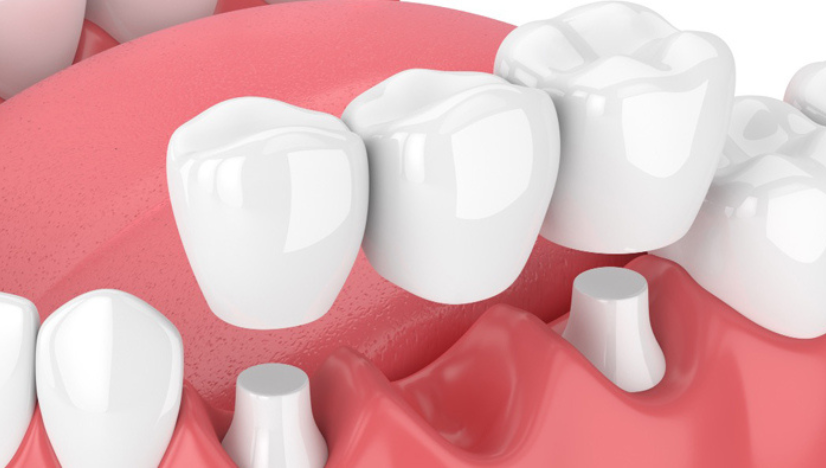 dental bridges