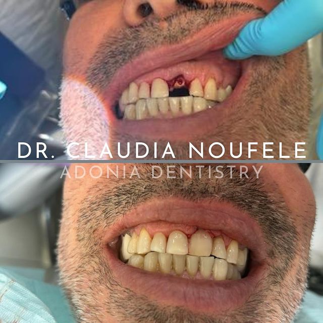 before and after dental implants transformation before and after dental implants transformation