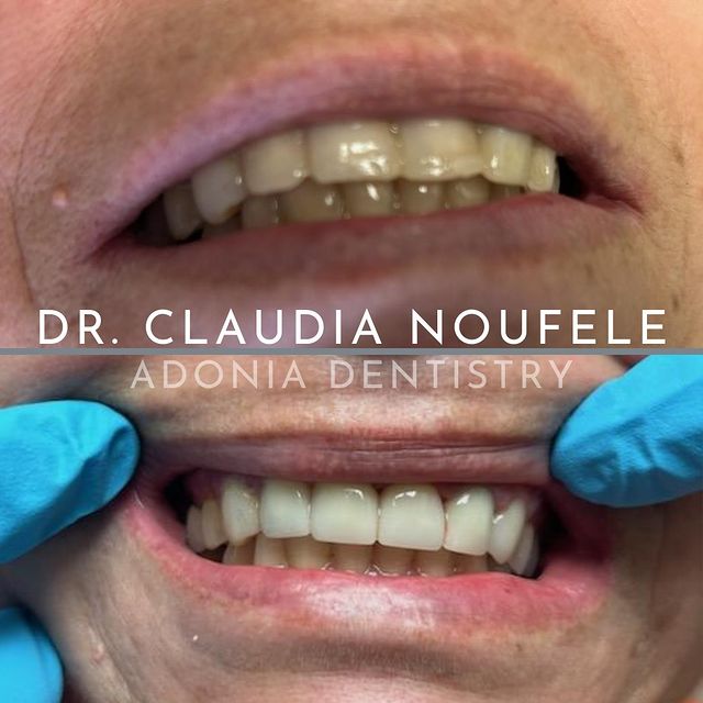 before and after teeth whitening transformation before and after teeth whitening transformation