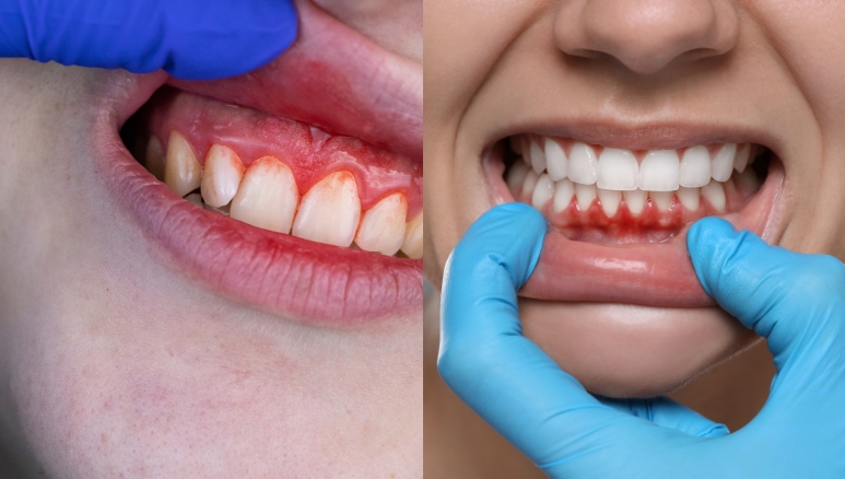 6 clear signs to schedule a dental cleaning before valentine’s day