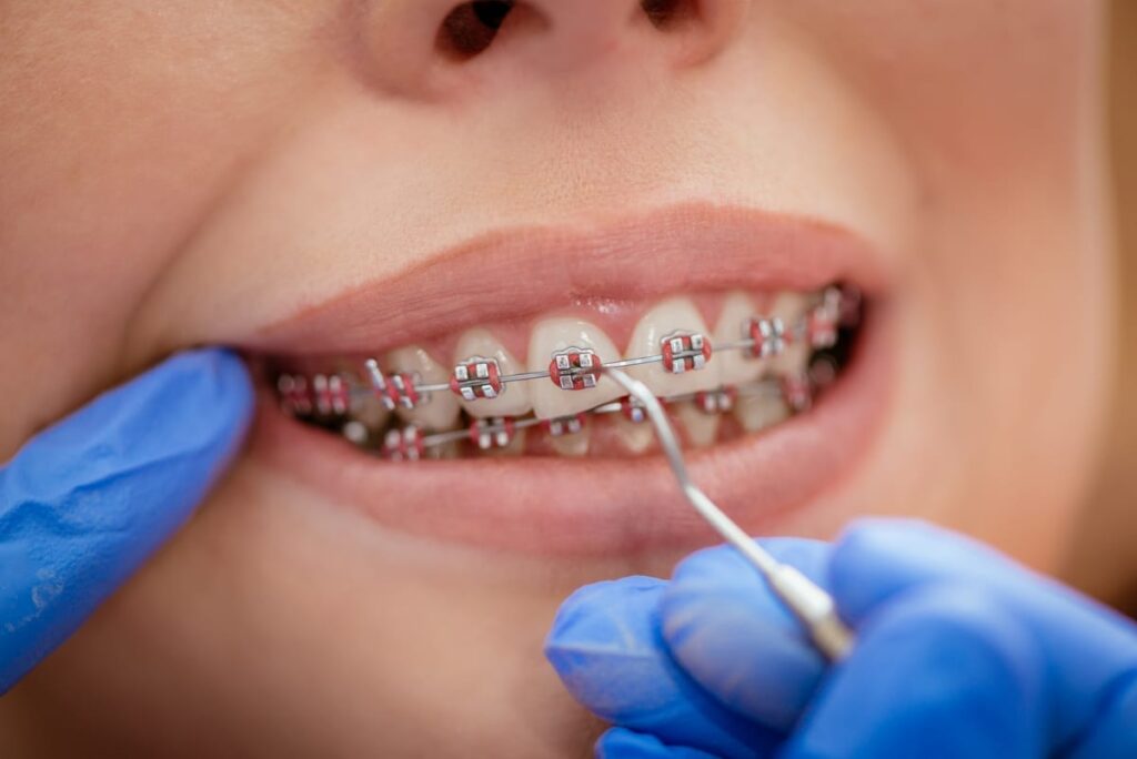Dental Bridges in Houston